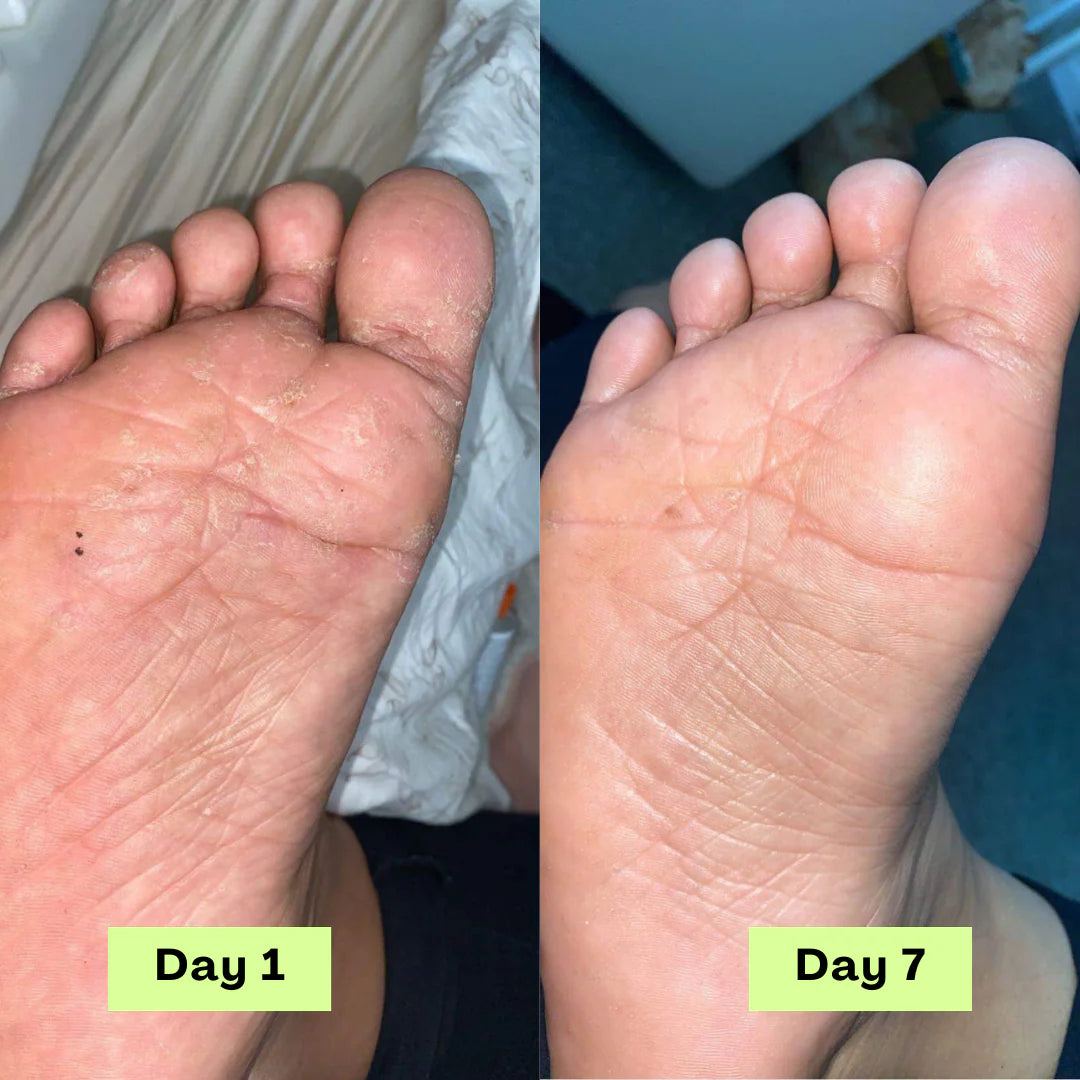 Calyra™ Antifungal Relief Bar