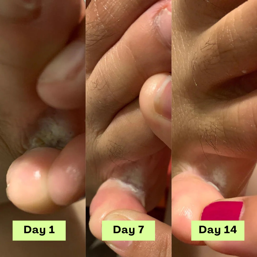 Calyra™ Antifungal Relief Bar