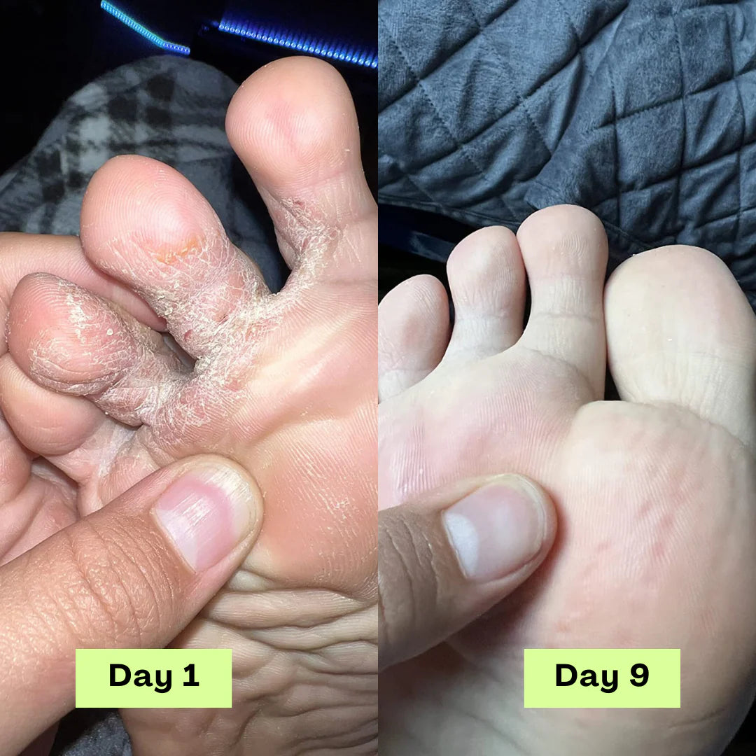 Calyra™ Antifungal Relief Bar