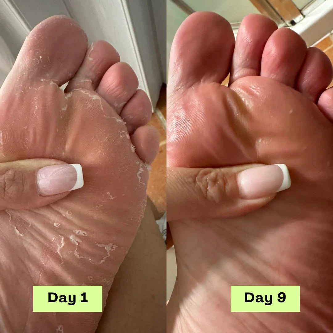 Calyra™ Antifungal Relief Bar